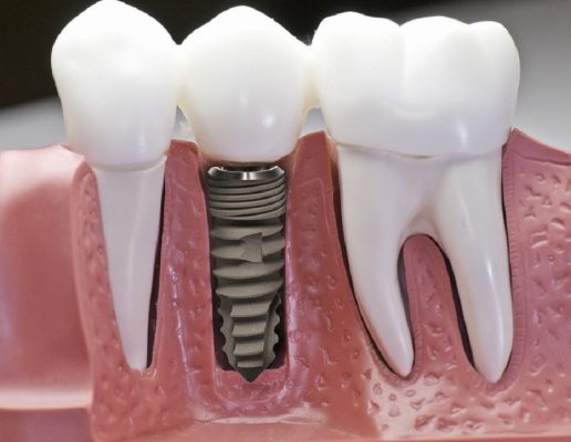 Dịch vụ trồng răng implant Thái Bình chất lượng uy tín nhất 2024