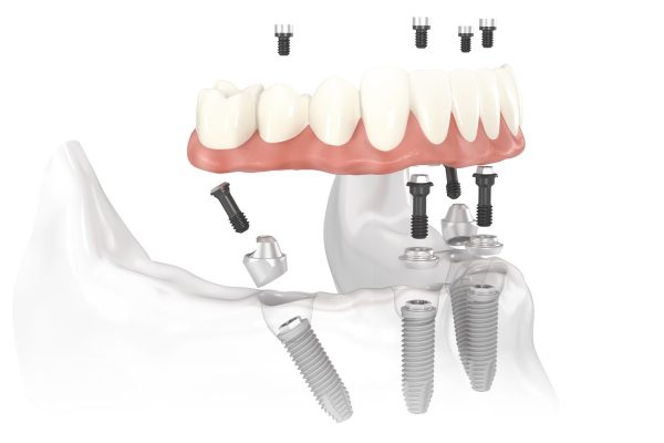 Ưu điểm của công nghệ trồng răng implant Thái Bình