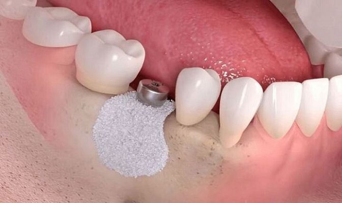 Ghép xương trong cấy ghép implant tại Thái Bình