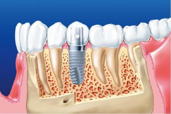 Trồng răng implant Thái Bình công nghệ mới không đau an toàn