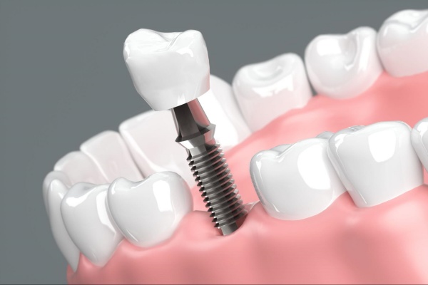 Trồng răng implant tại Thái Bình có những ưu điểm nổi bật gì?