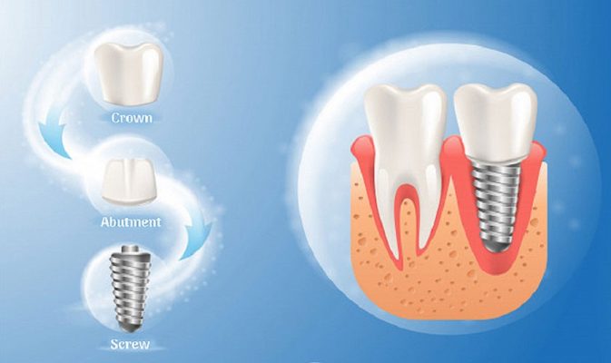 Trồng răng implant Thái Bình hệ thống nha khoa tiêu chuẩn quốc tế