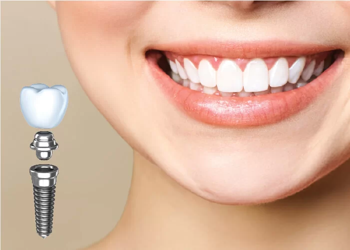 Cấy ghép implant gồm những loại nào?