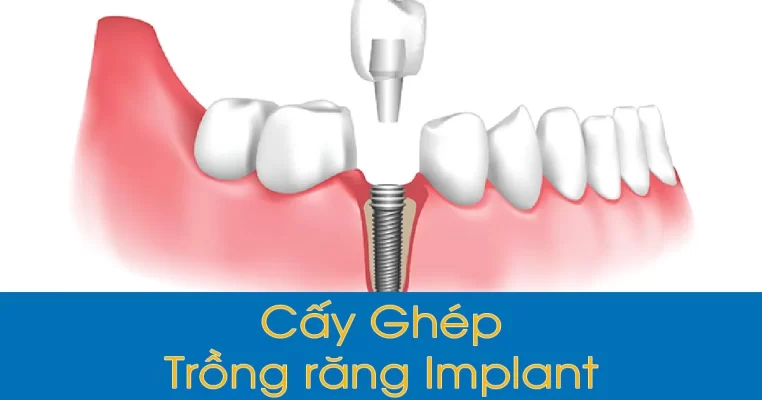Trồng răng implant Thái Bình là gì? Đối tượng nên trồng răng Implant