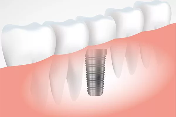 Có nên trồng implant Thái Bình không? Quy trình trồng implant