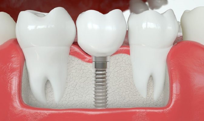 Nha Khoa Ngọc - phòng khám trồng răng implant Thái Bình chất lượng tốt