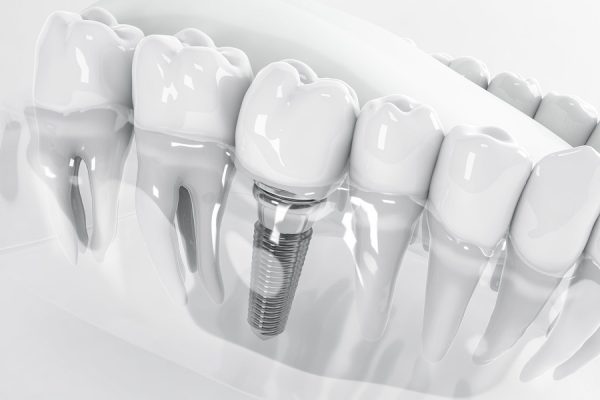 Trung tâm nha khoa uy tín chuyên trồng răng implant Thái Bình