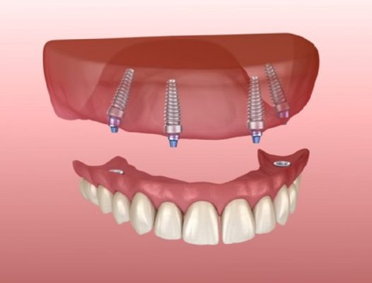 Trồng răng implant Thái Bình mất bao lâu và kế hoạch điều trị