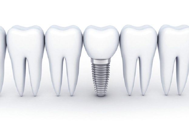 Trồng răng implant Thái Bình - Địa chỉ cấy ghép implant uy tín