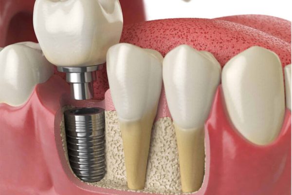 Trồng răng implant Thái Bình có ưu điểm gì?
