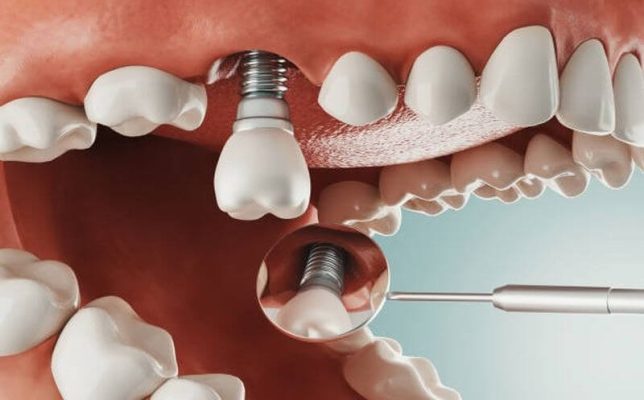 Trồng răng implant Thái Bình giá đắt hay rẻ