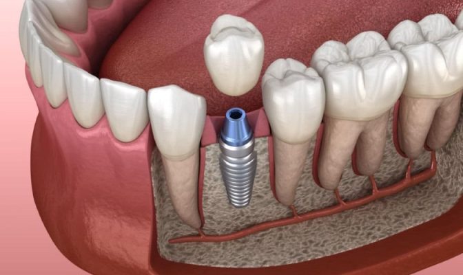Trồng răng implant Thái Bình - giải pháp hiệu quả số 1 hiện nay