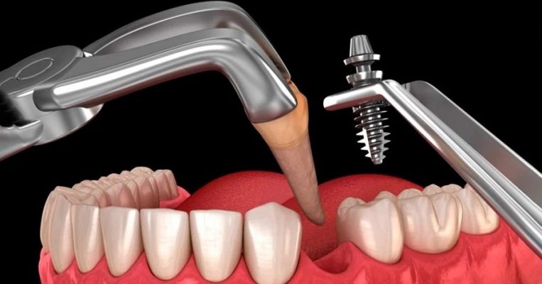 Địa chỉ trồng răng implant Thái Bình được khách hàng tin chọn