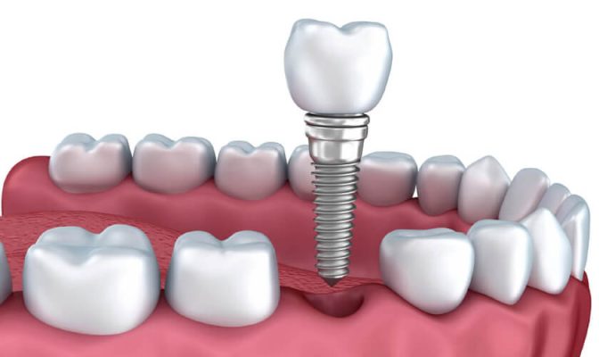 Địa chỉ trồng răng implant Thái Bình uy tín chất lượng nhất