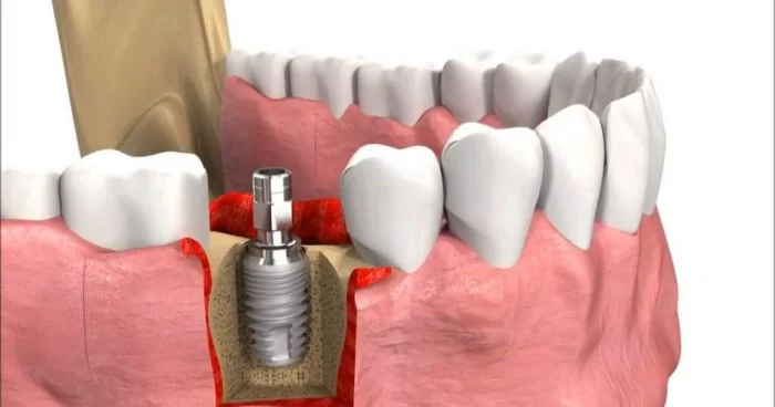 Dịch vụ trồng răng implant Thái Bình mang lại nhiều ưu điểm